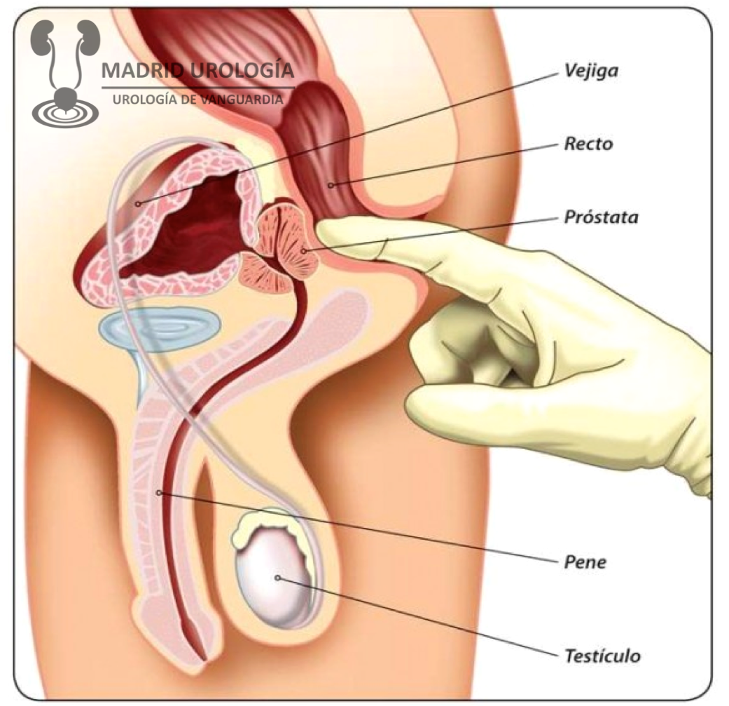 tacto rectal próstata